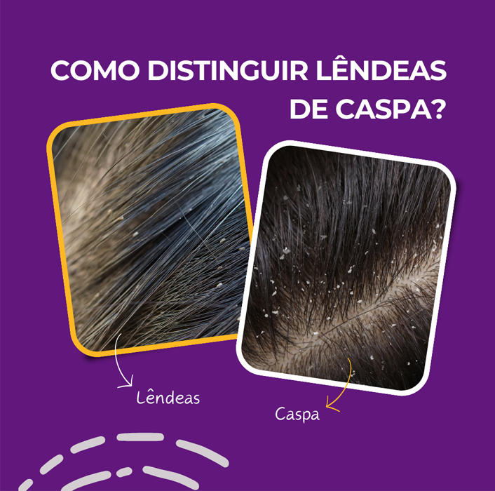 ✨ Lêndeas ou caspa? Descubra a diferença! ✨